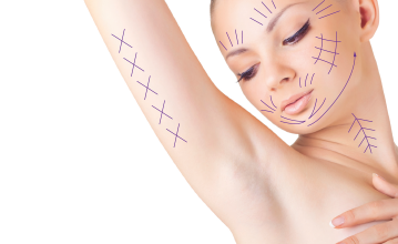 Eine Frau mit Markierungen an Gesicht und Arm zur Fadenlifting Behandlung